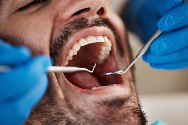 Best Emergency Tooth Extraction in Aurora, IN